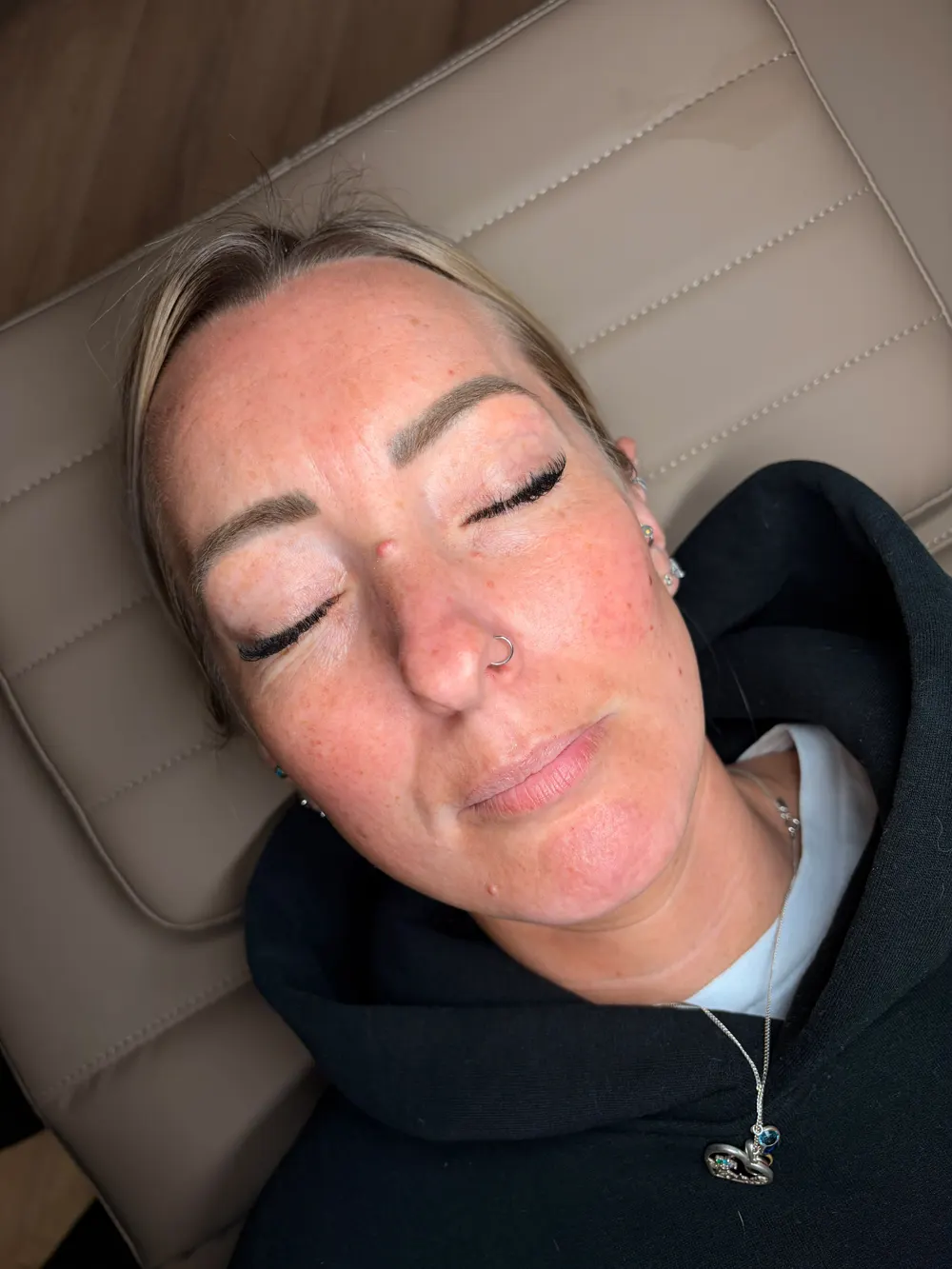 Lip filler before, SM Aesthetics Clinic Margate