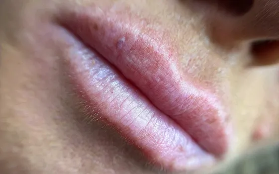 Lip blush before, SM Aesthetics Clinic Margate