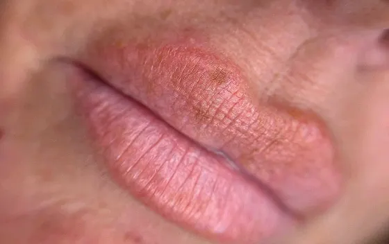 Lip blush before, SM Aesthetics Clinic Margate
