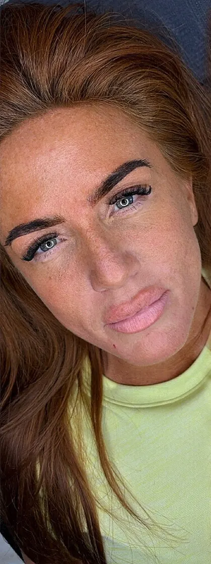 Lip blush before, SM Aesthetics Clinic Margate