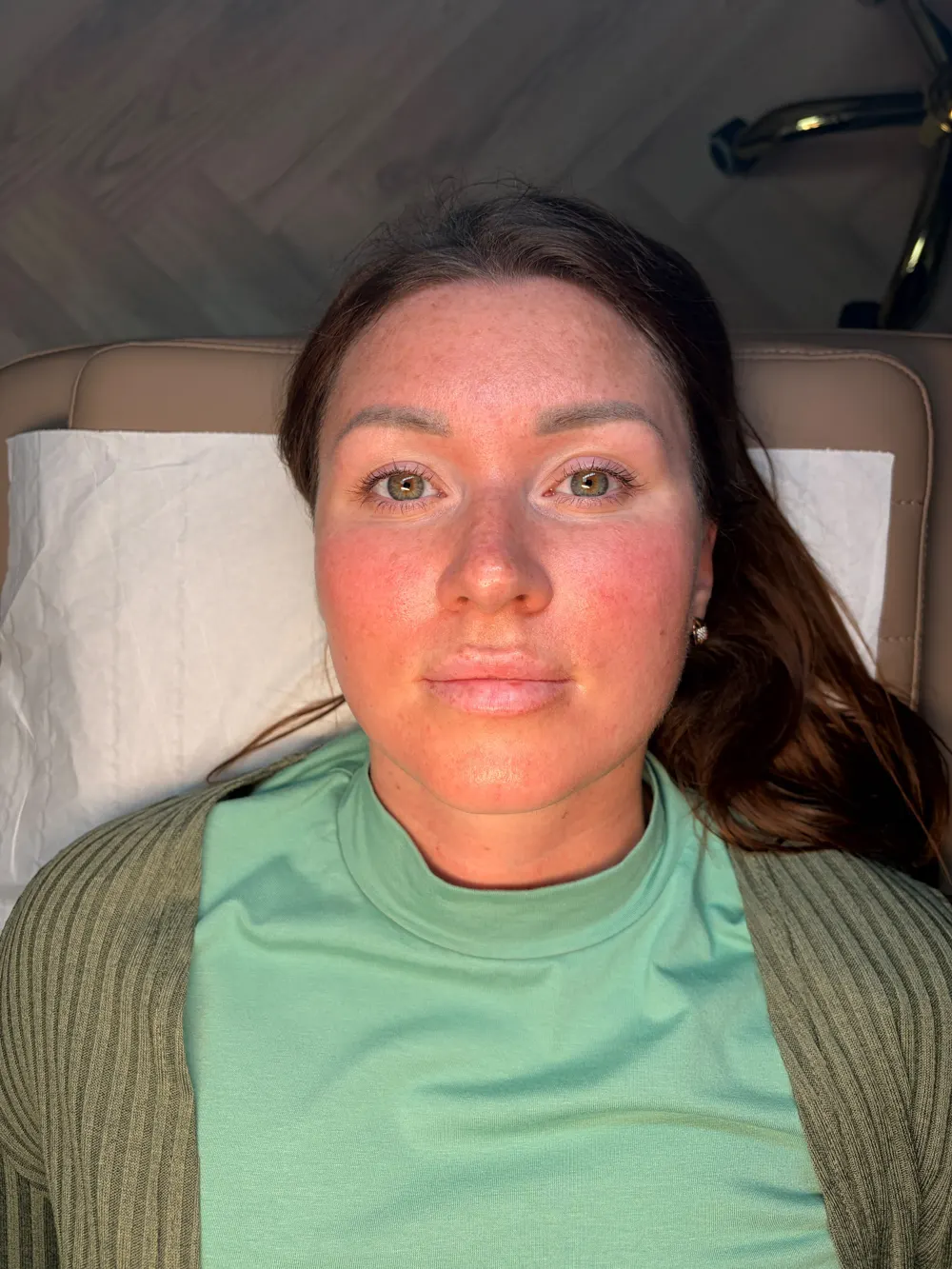 Lip blush before, SM Aesthetics Clinic Margate